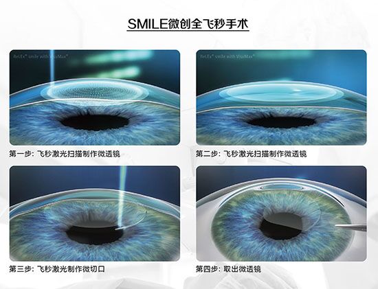 蔡司全飛秒、蔡司半飛秒近視手術(shù)與宇航飛秒的區(qū)別