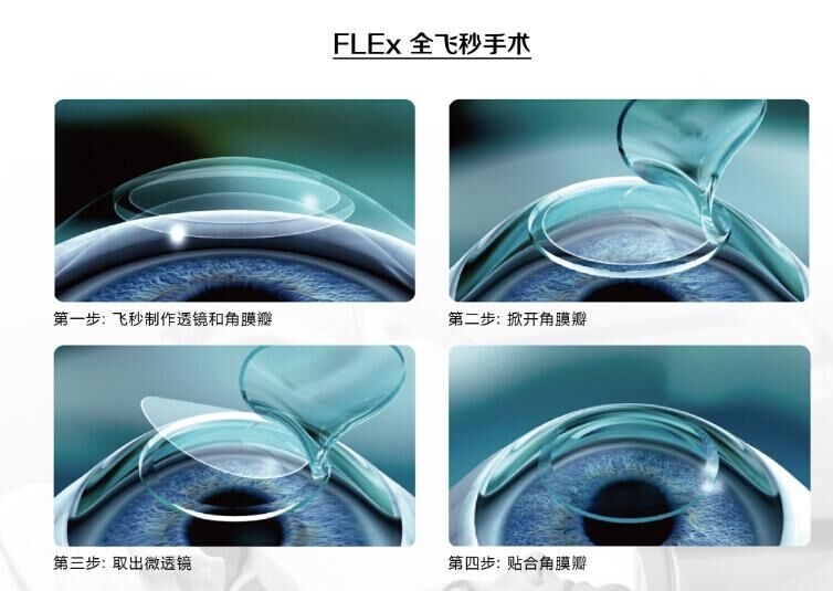 蔡司全飛秒、蔡司半飛秒近視手術(shù)與宇航飛秒的區(qū)別