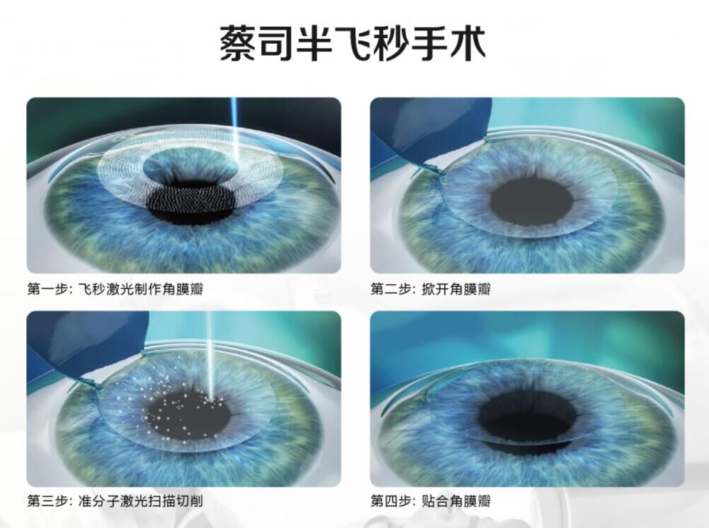 蔡司全飛秒、蔡司半飛秒近視手術(shù)與宇航飛秒的區(qū)別