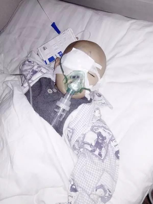 3歲唐氏綜合癥男孩罹患先天性白內(nèi)障，人工晶體植入