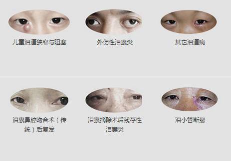 12月17日，普瑞集團淚道專家來疆親診，預(yù)約請速！