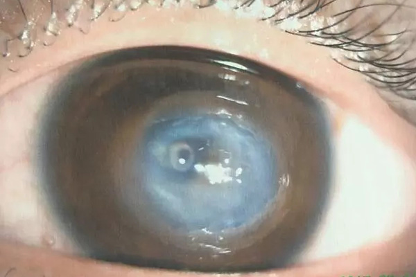 角膜移植，讓眾多患者重見光明