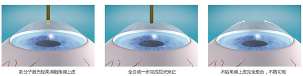 西北首臺(tái)千頻阿瑪仕落戶(hù)普瑞眼科，近視手術(shù)可以做哦~