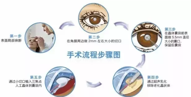 12月23日，普瑞眼科白內(nèi)障患者答謝會邀您參加!
